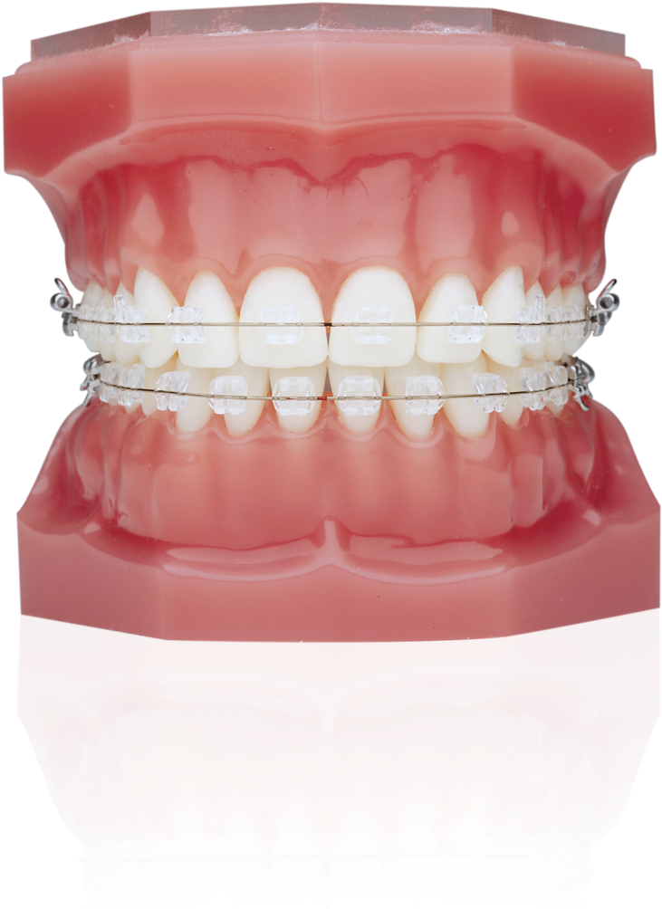 Ceramic Braces Vs Invisalign (812x1025), Png Download