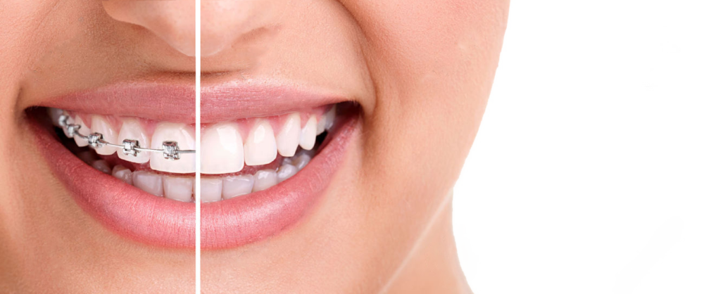 Woman Smiling Braces No Braces - Dental Braces (1000x418), Png Download