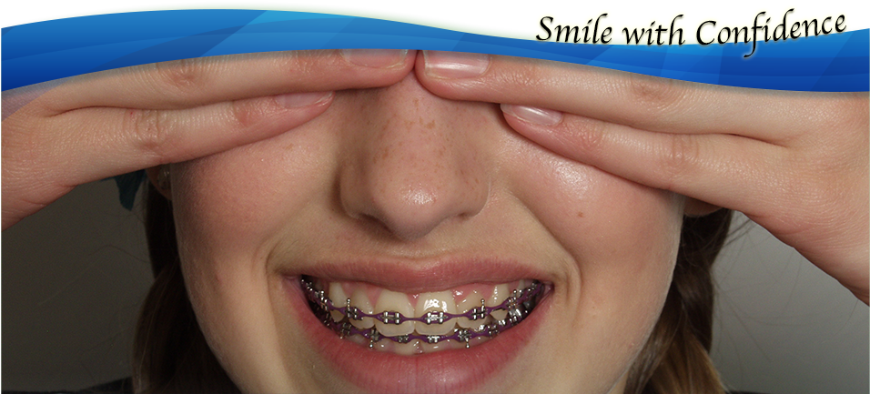 Life With Braces - Close-up (955x464), Png Download