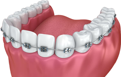 Braces - Dental Braces (501x318), Png Download