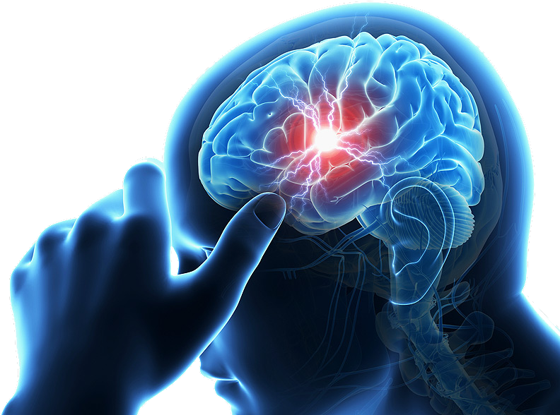 Brain Stroke (800x600), Png Download