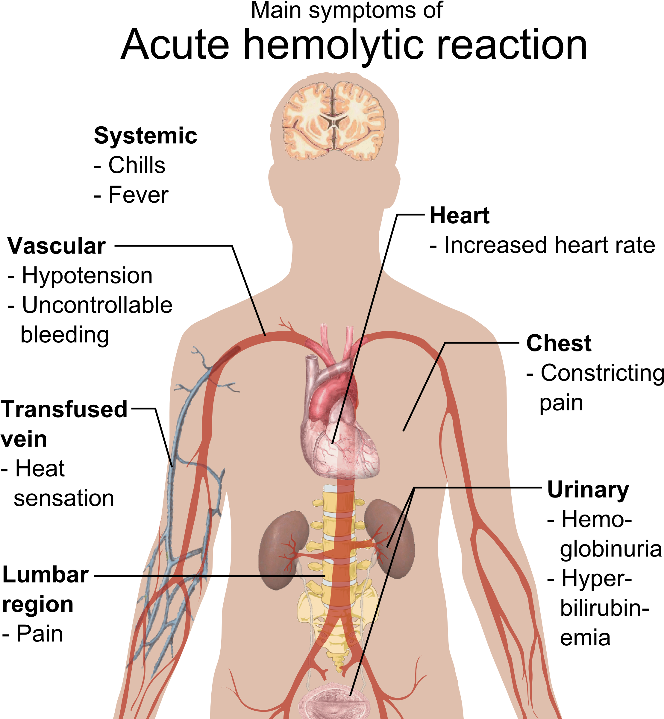Main Symptoms Of Acute Hemolytic Reaction - Acute Hemolytic Reaction (2262x2420), Png Download