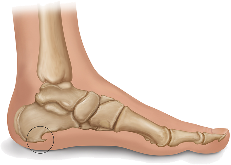 Heel Spur Illustration - Heel Spur (1200x628), Png Download