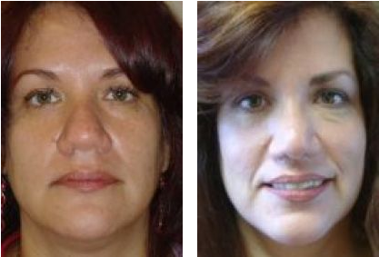 Nose Surgery Before & After Photos - Girl (450x316), Png Download