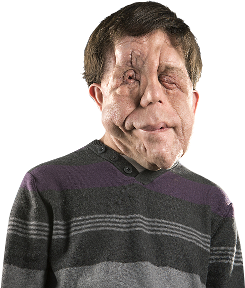 Film Blog Disfigured Heroes Like Deadpool Help People - Adam Pearson (720x600), Png Download
