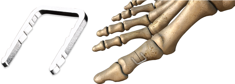 Charlotte™ Quick Staple - Bunion (847x300), Png Download