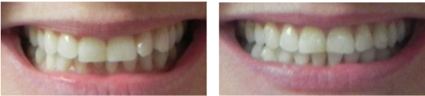 Before And After Orthodontics Treatment Case - Dental Braces (600x230), Png Download
