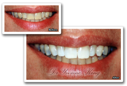 White Teeth Png Index Of - Tooth Whitening (440x298), Png Download