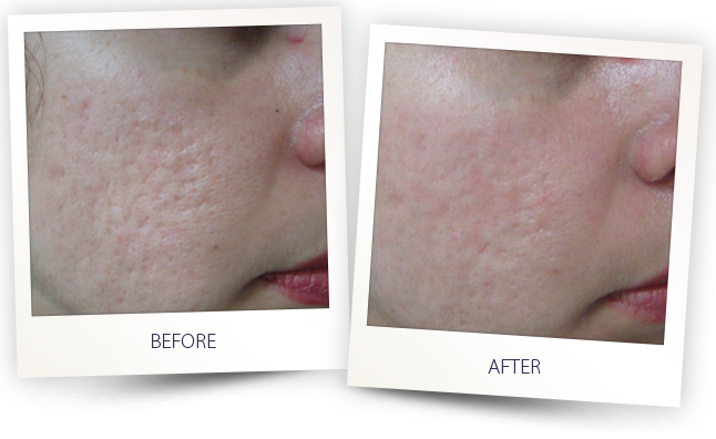 Legato Laser For Acne Scars (646x396), Png Download