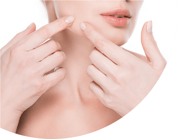Acne Face (768x592), Png Download
