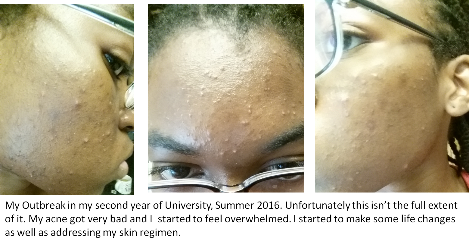 Second Year Acne Before - Acne (1575x803), Png Download