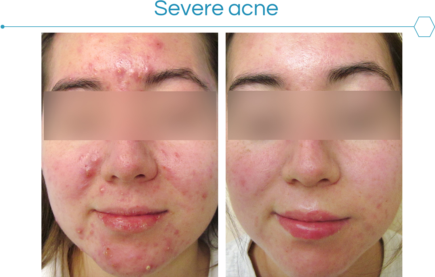 Acne Can Be Very Frustrating To The Patient And Have - Acne (1385x954), Png Download