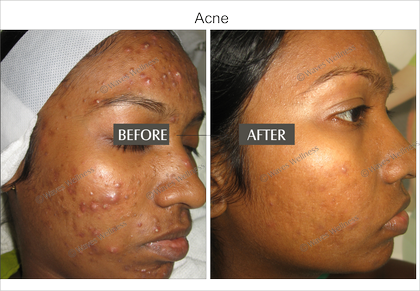 Acne And Marks - Acne (420x291), Png Download