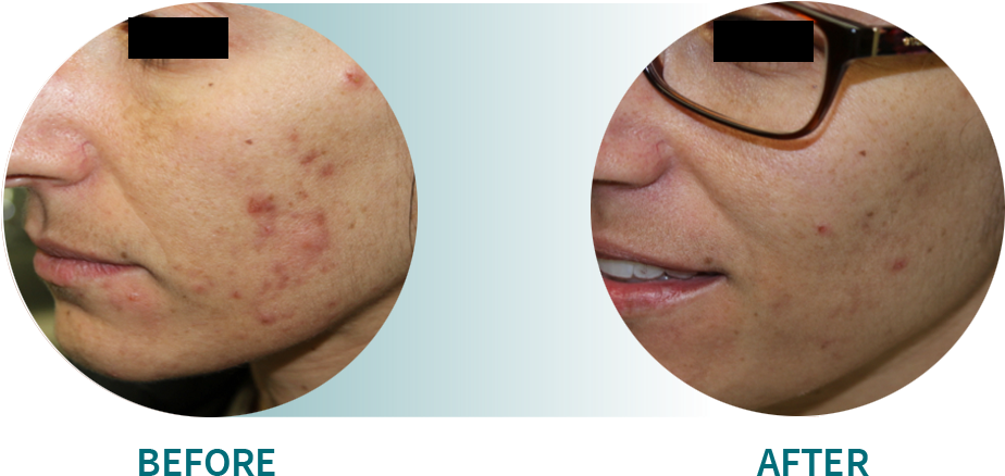 Active Acne/acne Scars - Stretch Marks Before And After (926x463), Png Download