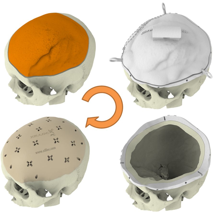 Meningioma 1 Stage - Cake (933x898), Png Download