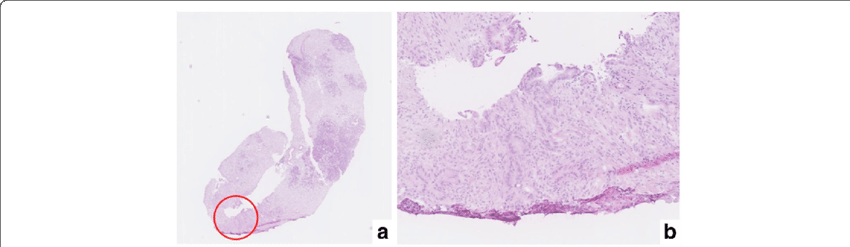Pathological Analysis By Open Surgical Biopsy In Case - Drawing (850x247), Png Download