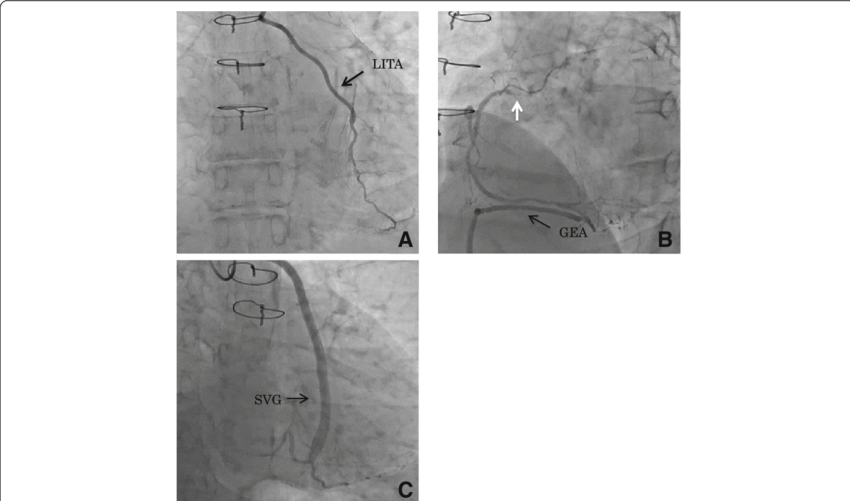 Preoperative Coronary Angiogram - Coronary Catheterization (850x501), Png Download