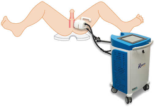 Penis Applicator (506x348), Png Download