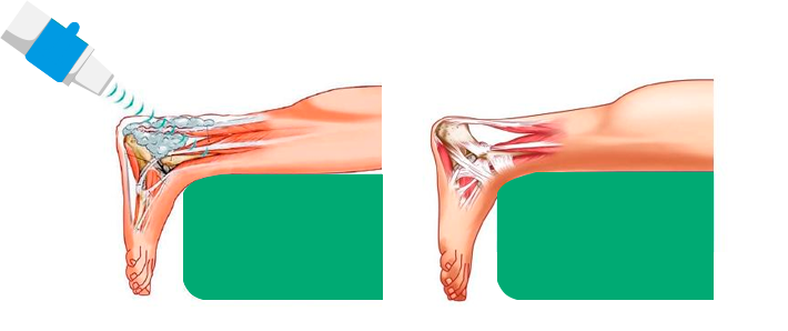 Extracorporeal Therapy Eswt Epat - Extracorporeal Shock Wave Plantar Fasciitis (710x298), Png Download