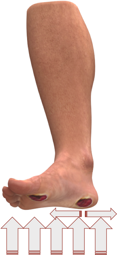 Physical Causes Of Diabetic Foot Ulcers - Diabetic Foot Ulcer (1500x901), Png Download