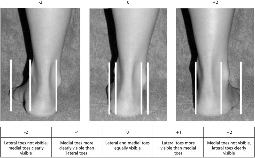 The Evaluation Of The Abduction/adduction Of The Forefoot - Foot Adduction (850x525), Png Download