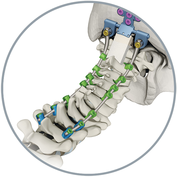 Atec Spine Products Solanas Featured Image - Nuvasive Vuepoint (600x600), Png Download