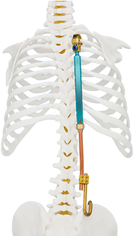 Veptr Ii Vertical Expandable Prosthetic Titanium Rib - Vertical Expandable Prosthetic Titanium Rib Veptr (522x336), Png Download