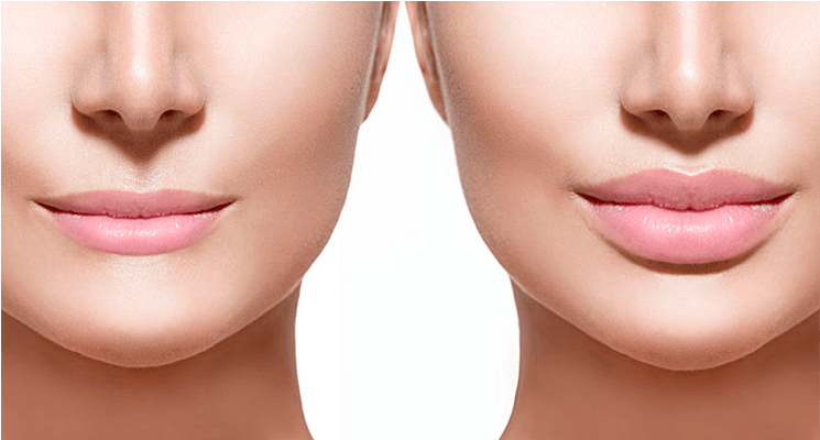 Relleno Labios - - 0.5 Ml Lips Before And After (1000x400), Png Download