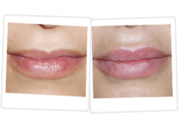 Aumento De Labios Cirugia - Surgery (629x407), Png Download