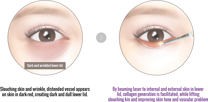 Some People May Notice Dark Under Eye Circles Moving - Eyelash Extensions (1000x430), Png Download