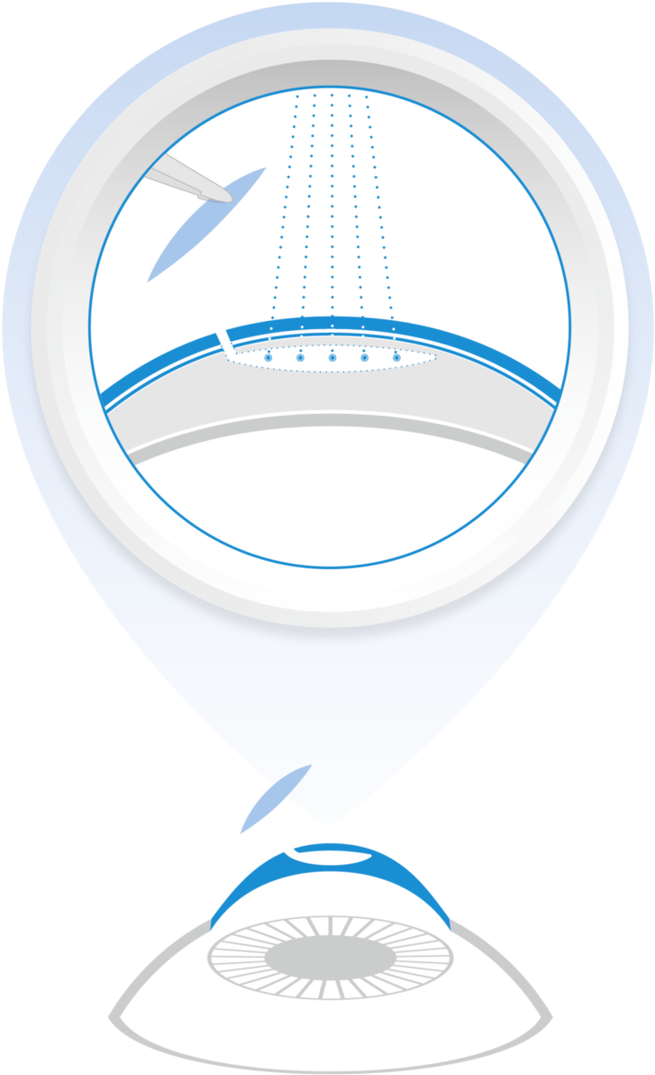 The New, Third-generation Smile Laser Surgery Unites - Circle (808x1280), Png Download