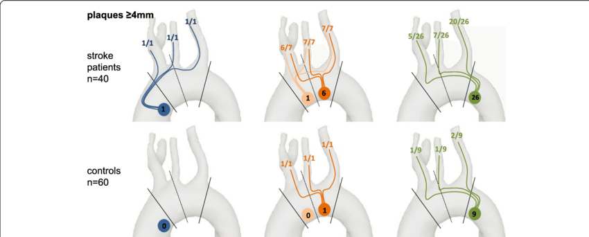 Number Of Plaques ≥4 Mm In Each Section Of The Aorta - Illustration (850x342), Png Download