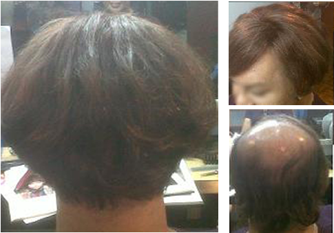 For A Person With Medical Conditions Such As Alopecia, - Lace Wig (540x371), Png Download