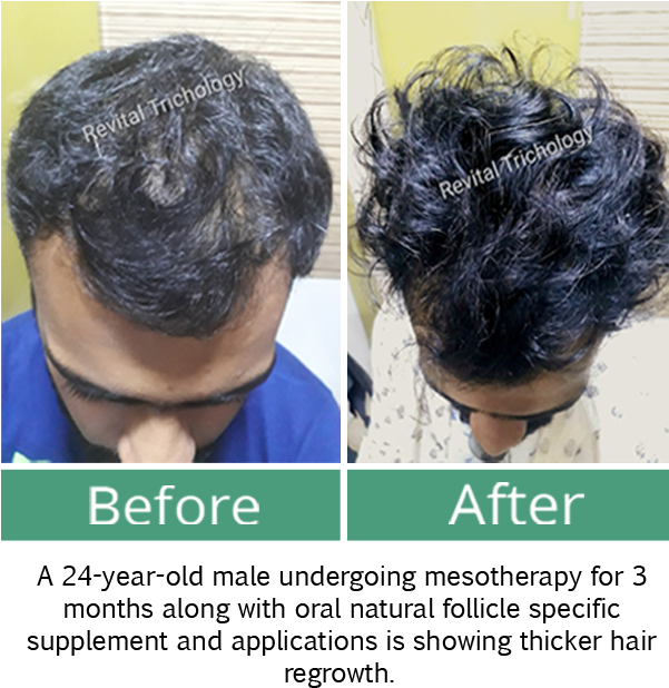 Hair Loss In Men - Lace Wig (600x650), Png Download