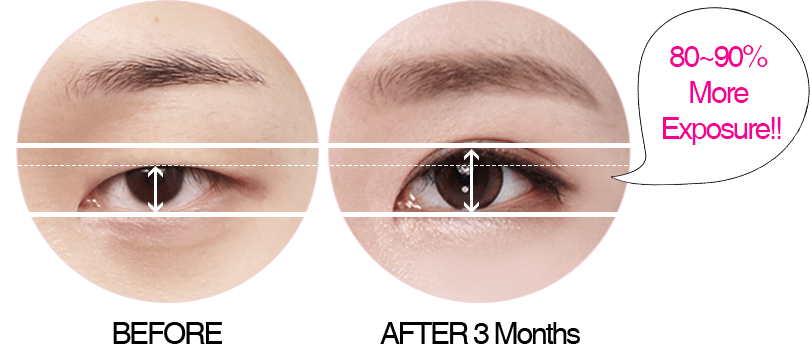 What Is Da's Ptosis Correction - Eye Shadow (810x344), Png Download