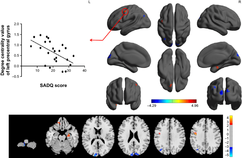 Between-group Differences In Binarized Degree Centrality - Superior Temporal Gyrus (850x556), Png Download