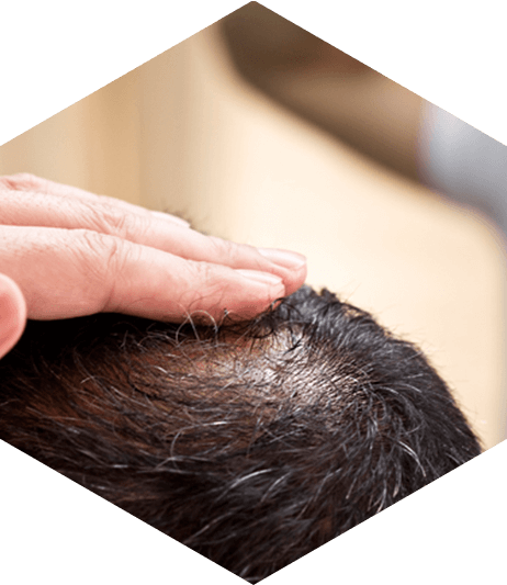 Causes Of Hair Loss In Men - Hair Loss (462x533), Png Download