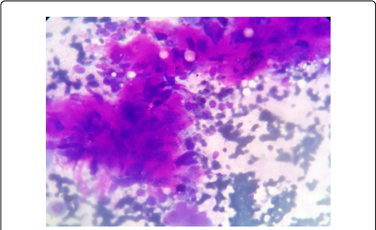 Clusters Consisting Of Tumor Cells With Spindle Cell - Spindle Cell Carcinoma (769x469), Png Download