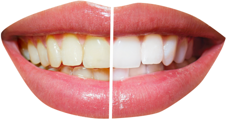Teeth Whitening Png Transparent Image - Dentistry Before And After (500x384), Png Download