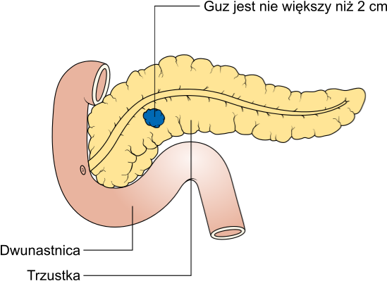 Diagram Showing Stage T1 Cancer Of The Pancreas Cruk - Rak W 4 Stadium (548x410), Png Download