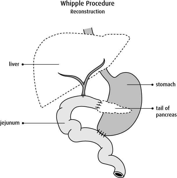 Diagram Of Reconstruction In A Whipple Procedure - Pancreaticoduodenectomy (609x612), Png Download