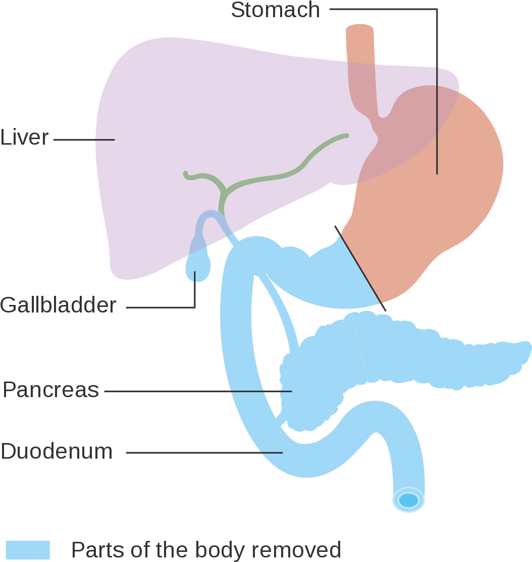 Download Total Pancreatectomy PNG Image with No Background