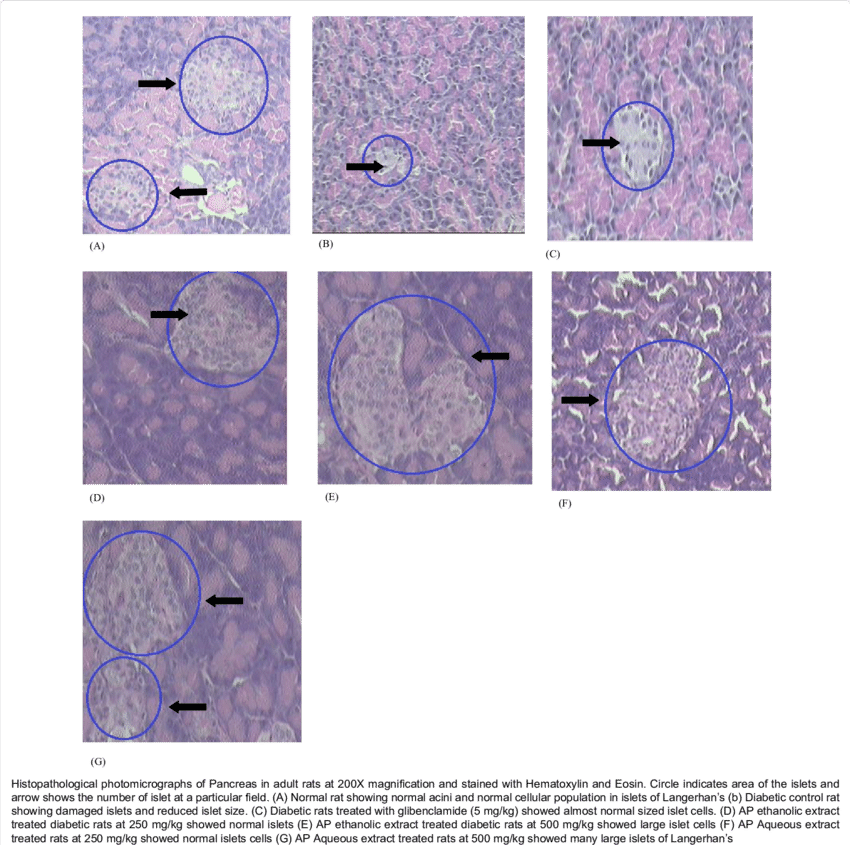 Histopathological Photomicrographs Of Pancreas - Diabetes Mellitus (850x845), Png Download
