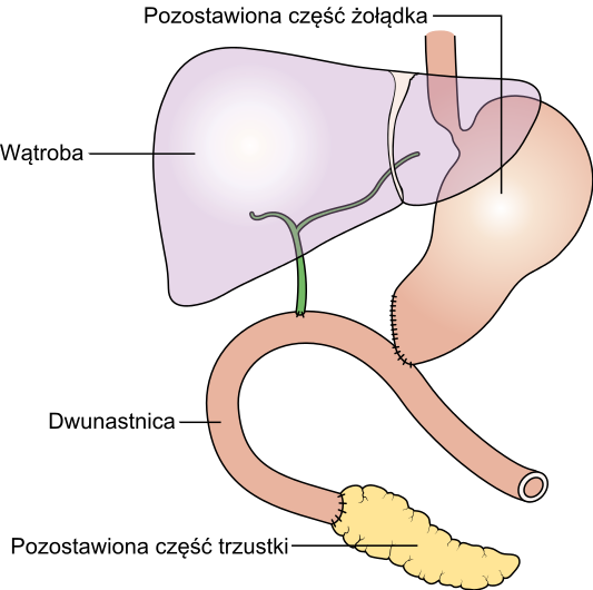 Diagram Showing How The Pancreas And Bowel Is Joined - Pancreatectomy (533x530), Png Download