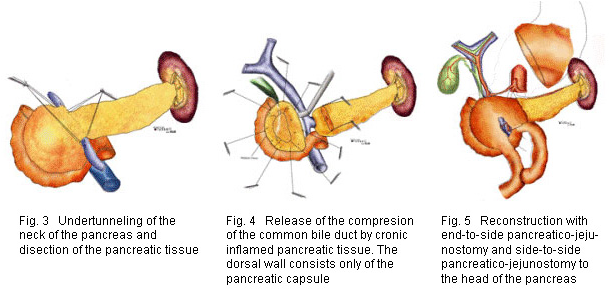 Pankreaskopfresektion - Резекция Головки Поджелудочной Железы (624x289), Png Download