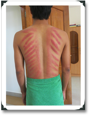 Https - //mnshrink - Files - Wordpress - Com/2013/08/019 - Cambodian Coining (332x420), Png Download