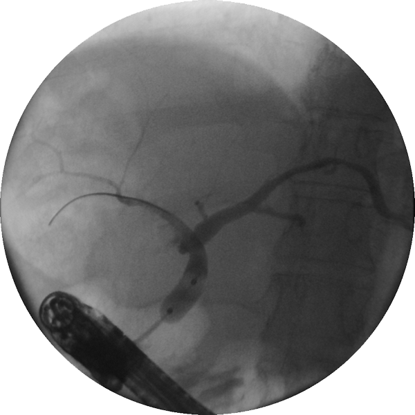 Dilation Of A Stricture With The Hurricane Rx Biliary - Hurricane Balloon (600x600), Png Download