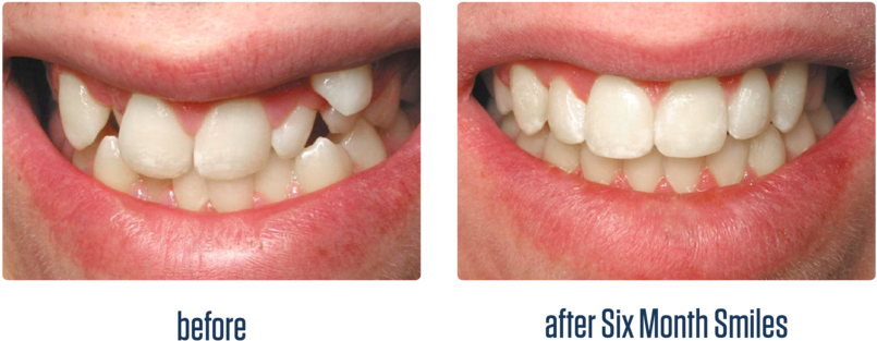 Gallery-07 - Before And After Six Month Smiles (1000x434), Png Download