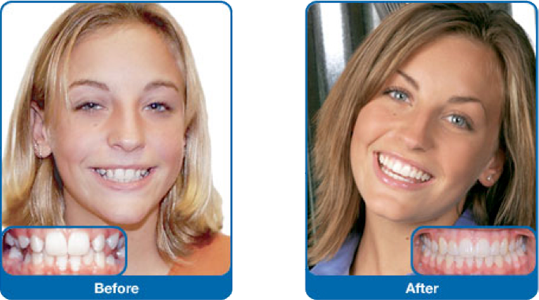 Damon Smile - Damon Braces Before And After Adults (539x300), Png Download