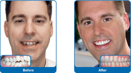 Damon Smile - Damon Braces Adults Before After (539x300), Png Download